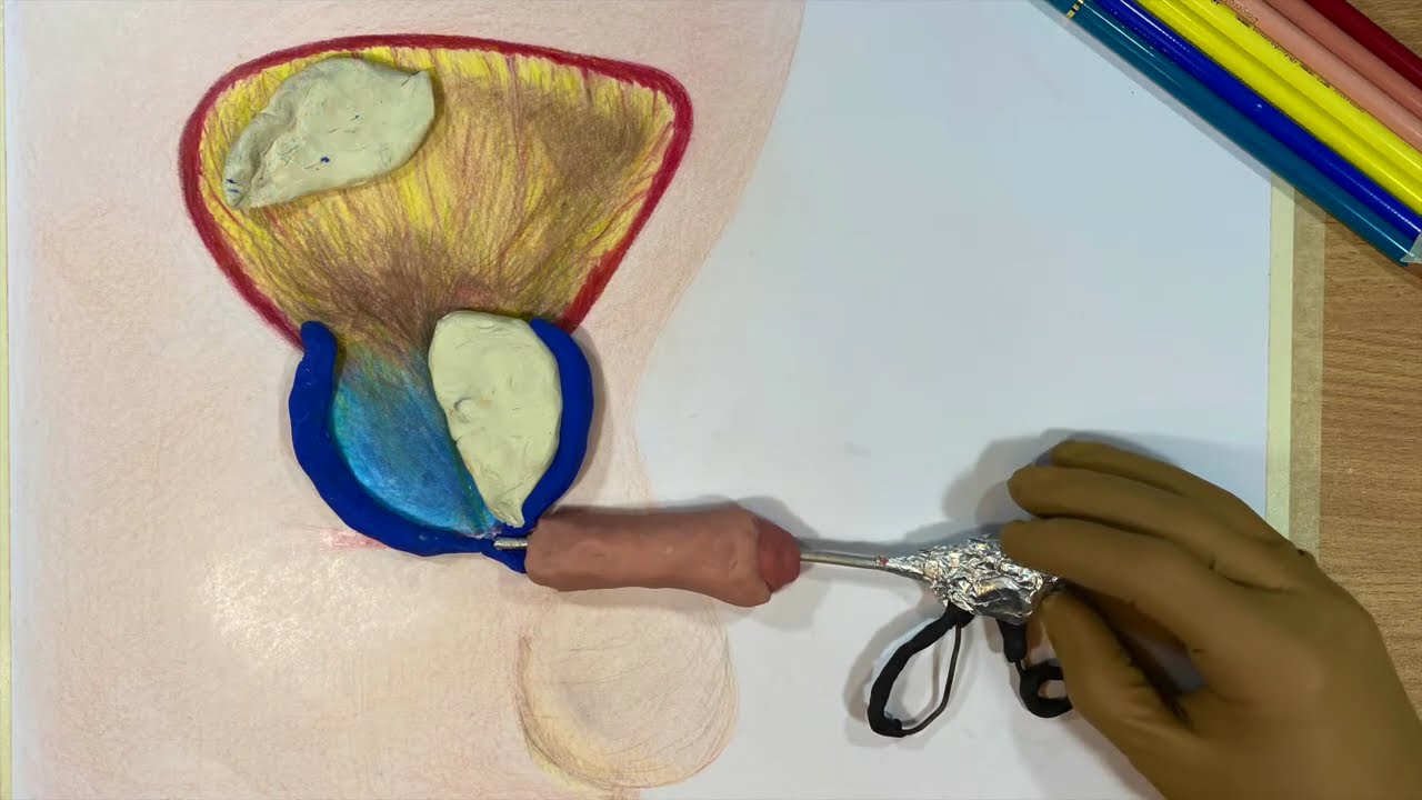 cubre asisa cirugía láser de próstata